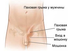 Паховая грыжа у мужчины одна из причин болей в лобковой кости