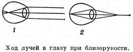 лучи в глазу при близорукости