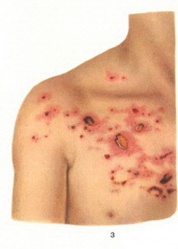 impetigo herpetiformis