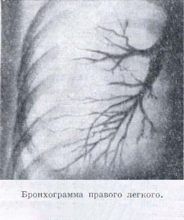 бронхограмма легкого