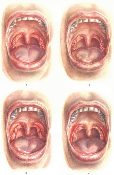 хронический тонзиллит фото