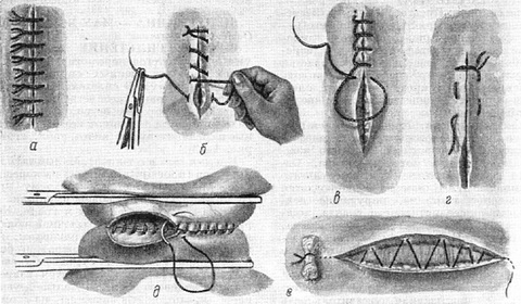 Схема хирургических швов