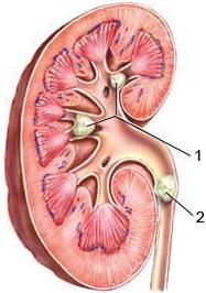 камни в почках