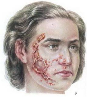 impetigo