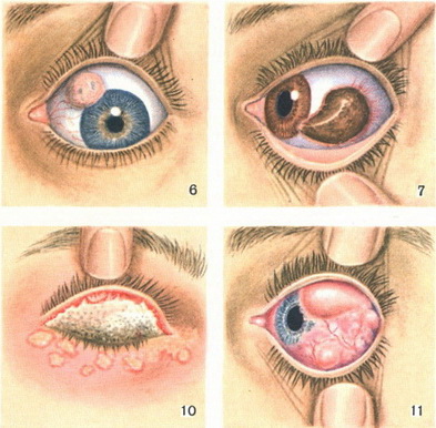 conjunctivitis