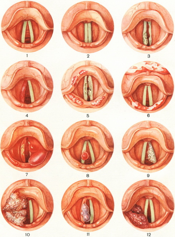 болезни гортани