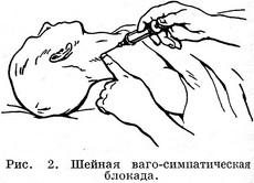 шейная ваго-симпатическая новокаиновая блокада