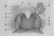 анатомические варианты небных миндалин