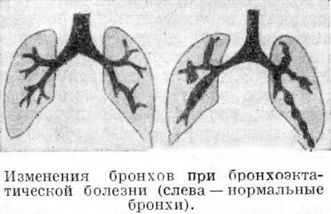 бронхоэктазы