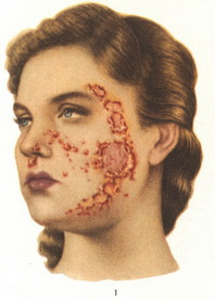 impetigo circinata