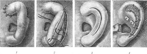 восстановление ушной раковины