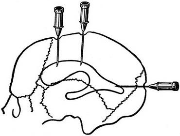 вентрикулопункция