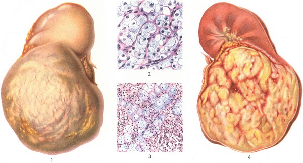 гипернефрома почки