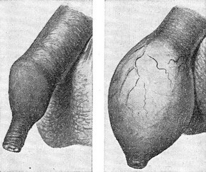 гипертрофический фимоз фото