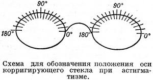 астигматизм