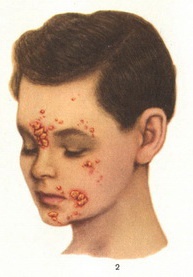 impetigo contagiosa