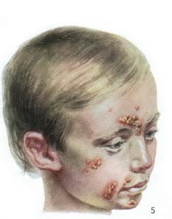 стрептококковое impetigo