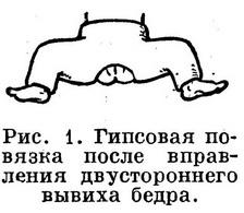 лечение врожденного вывиха бедра