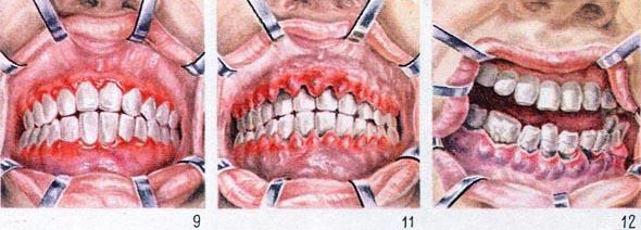 катальный, гипертрофический и цинготный гингивит