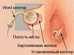 Один из методов лечения кисты бартолиновой железы