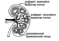 Клиническая картина инфаркта почки