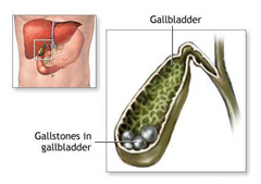 Желчнокаменная болезнь