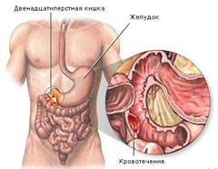 Симптомы желудочно кишечного кровотечения