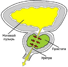 Простатит воспаление предстательной железы у мужчин