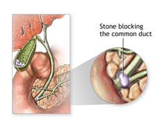 Симптомы и лечение желчнокаменной болезни