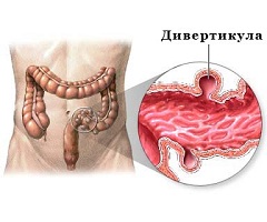 Дивертикулез образование на стенках кишечника дивертикул