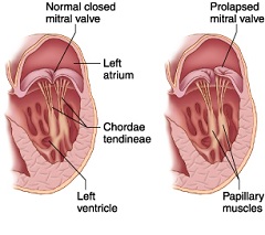 Пролапс митрального клапана провисание его створок