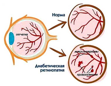Диабетическая ретинопатия