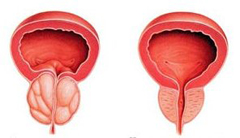 Признаки простатита