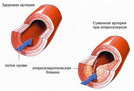 Атеросклероз