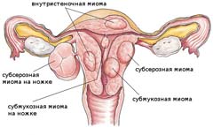 Виды миомы матки