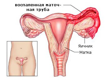 Виды и признаки оофорита