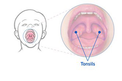 Причины тонзиллита