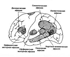 Классификация и формы афазии