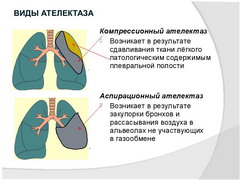 Виды ателектаза