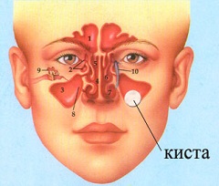 Истинная киста гайморовой пазухи 